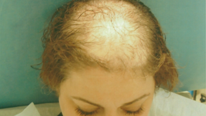 How to take care of baldness in women
