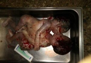 Conjoined twins delivered in Katsina state (Graphic photo).dailyfamily.ng