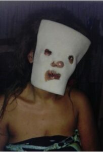 Man pours acid on his lover for breaking up with him, absconds afterwards.dailyfamily.ng