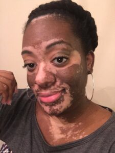 American bride to-be in tears as skin infection appears on her body -dailyfamily.ng