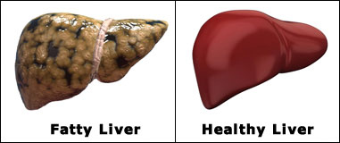 symptoms-of-fat-in-the-liver symptoms-of-fat-in-the-liver