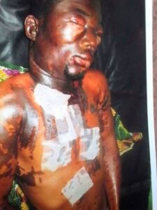 Man Pours Acid on His Niece and Her Lover, See Reason.dailyfamily.ng