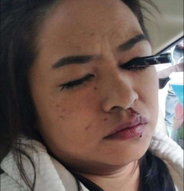 Shocking Eyeliner Pencil Stuck in Lady's Eye (See Photos)