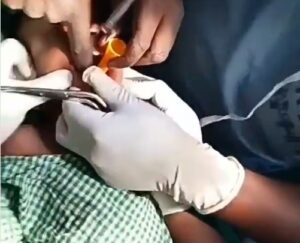 Doctors Removes Toy Stuck In Boy’s Throat2.dailyfamily.ng