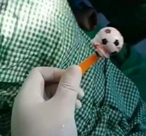 Doctors Removes Toy Stuck In Boy’s Throat4.dailyfamily.ng